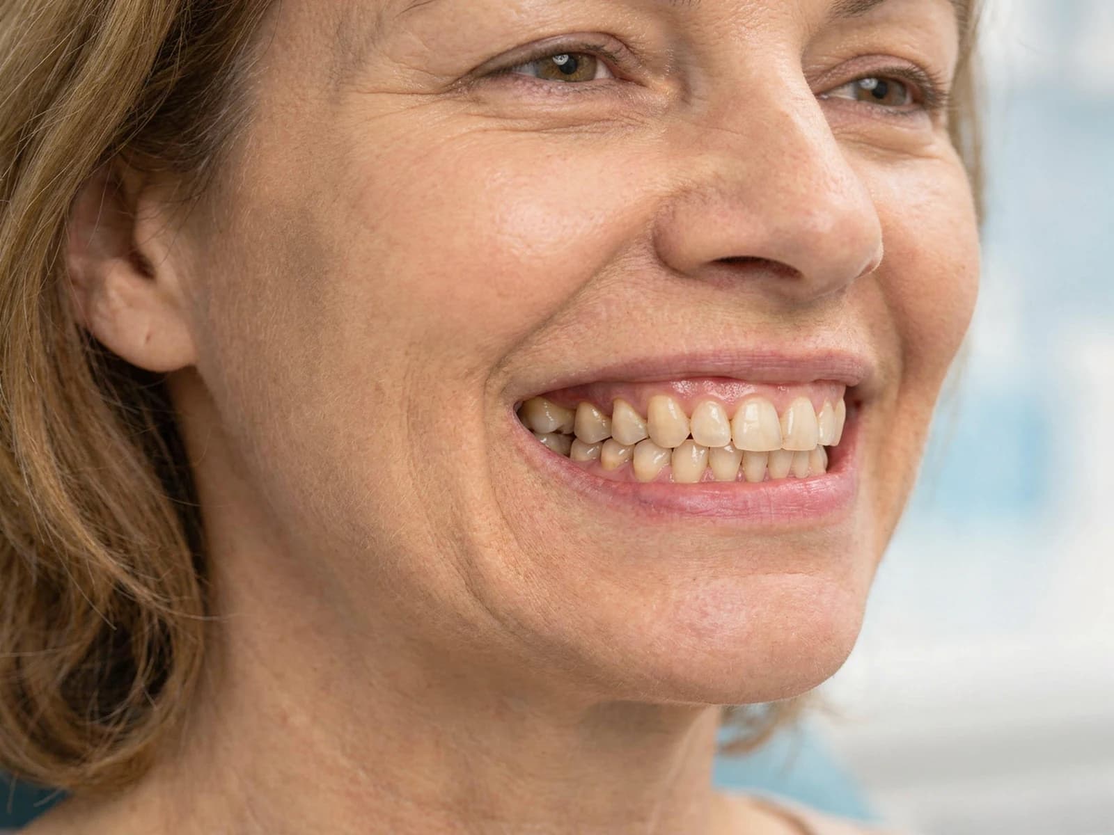 After: 3-tooth bridge