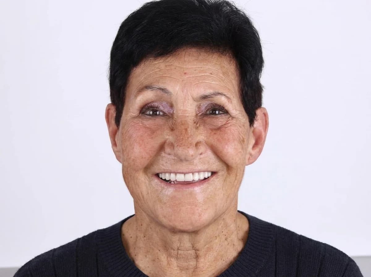 A natural-looking smile restored with All-on-4 implants