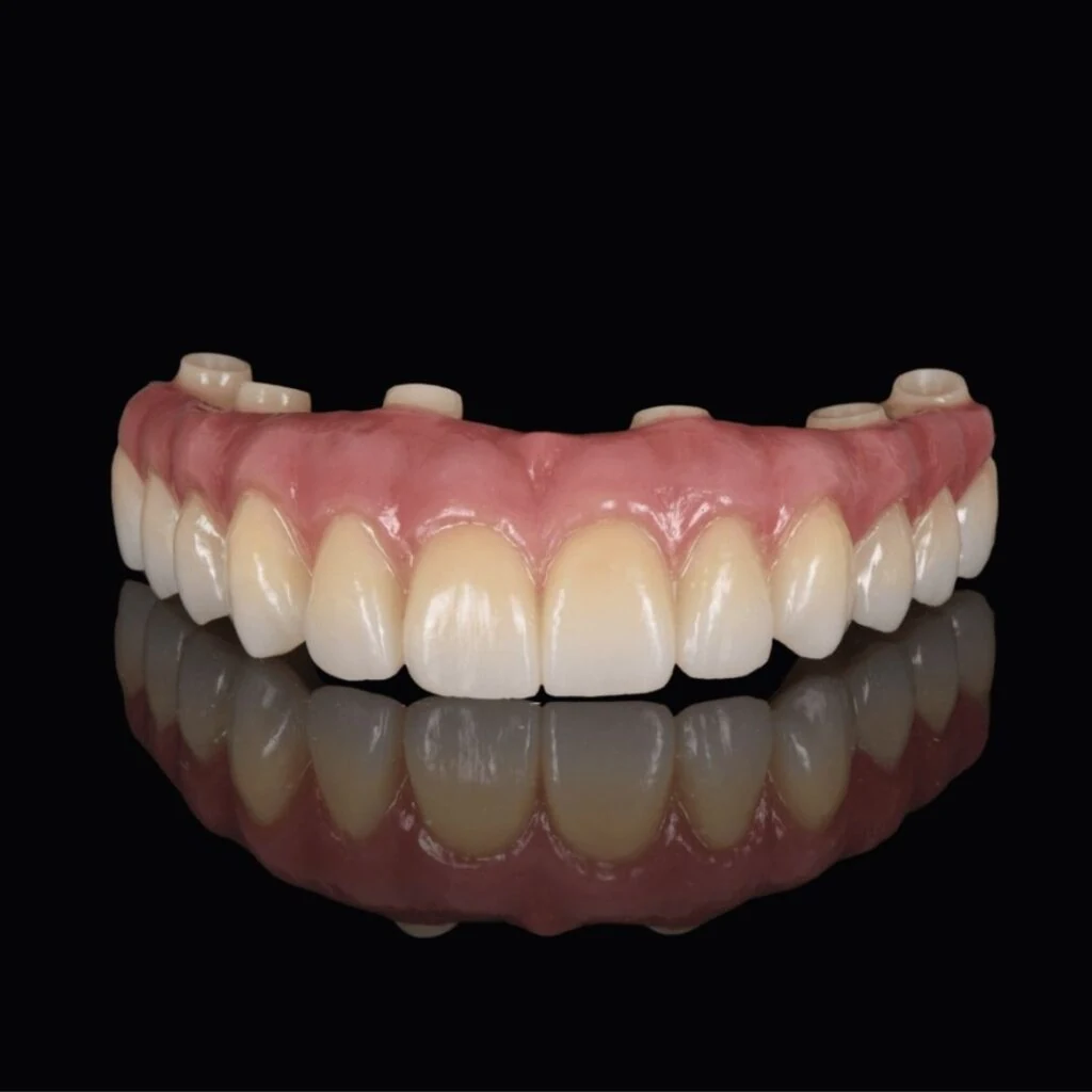 Dental implant denture held during fitting