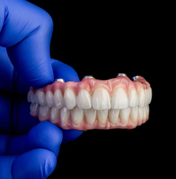 Full-arch dental implant restoration