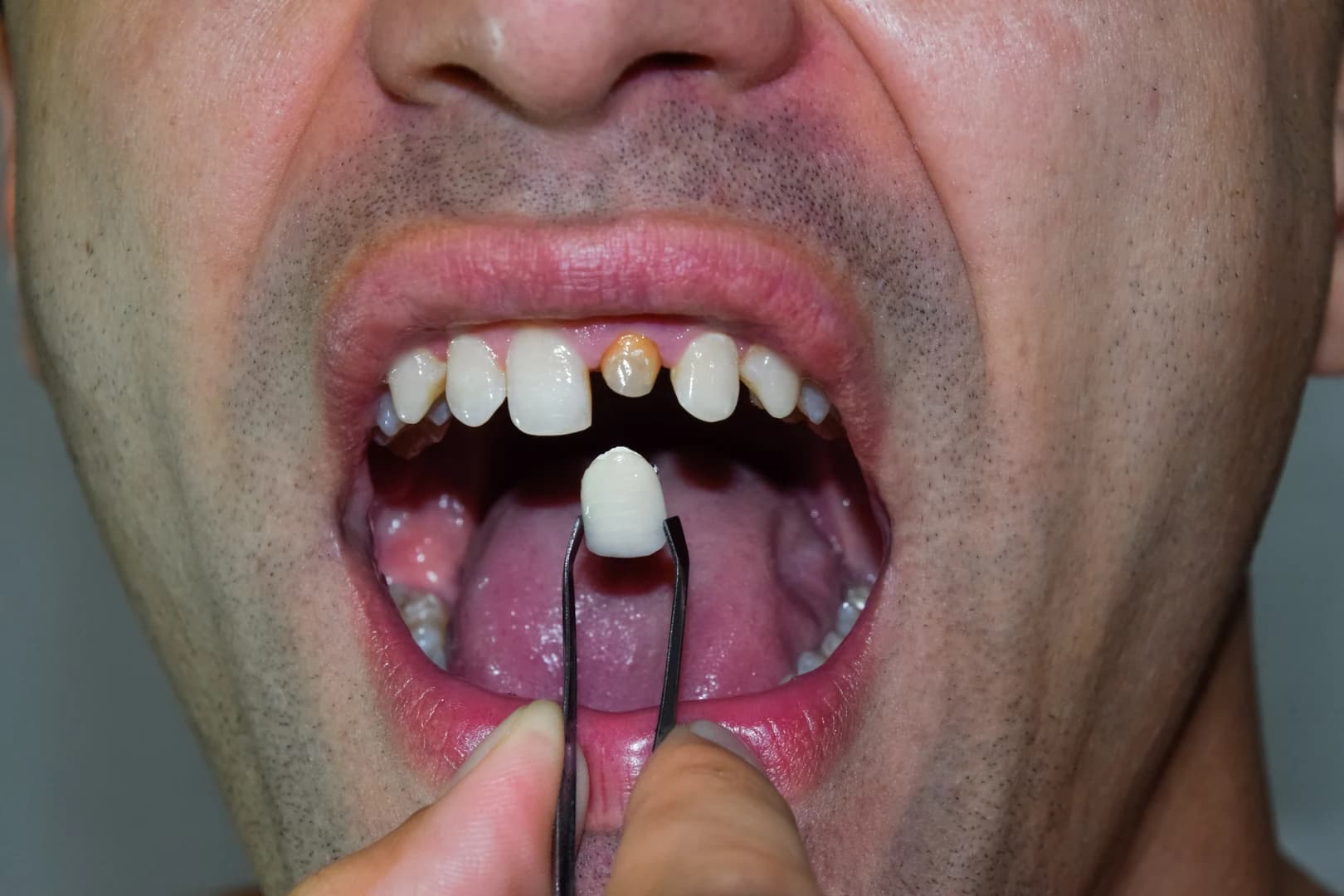 Dentist ready to replace a lost filling or crown