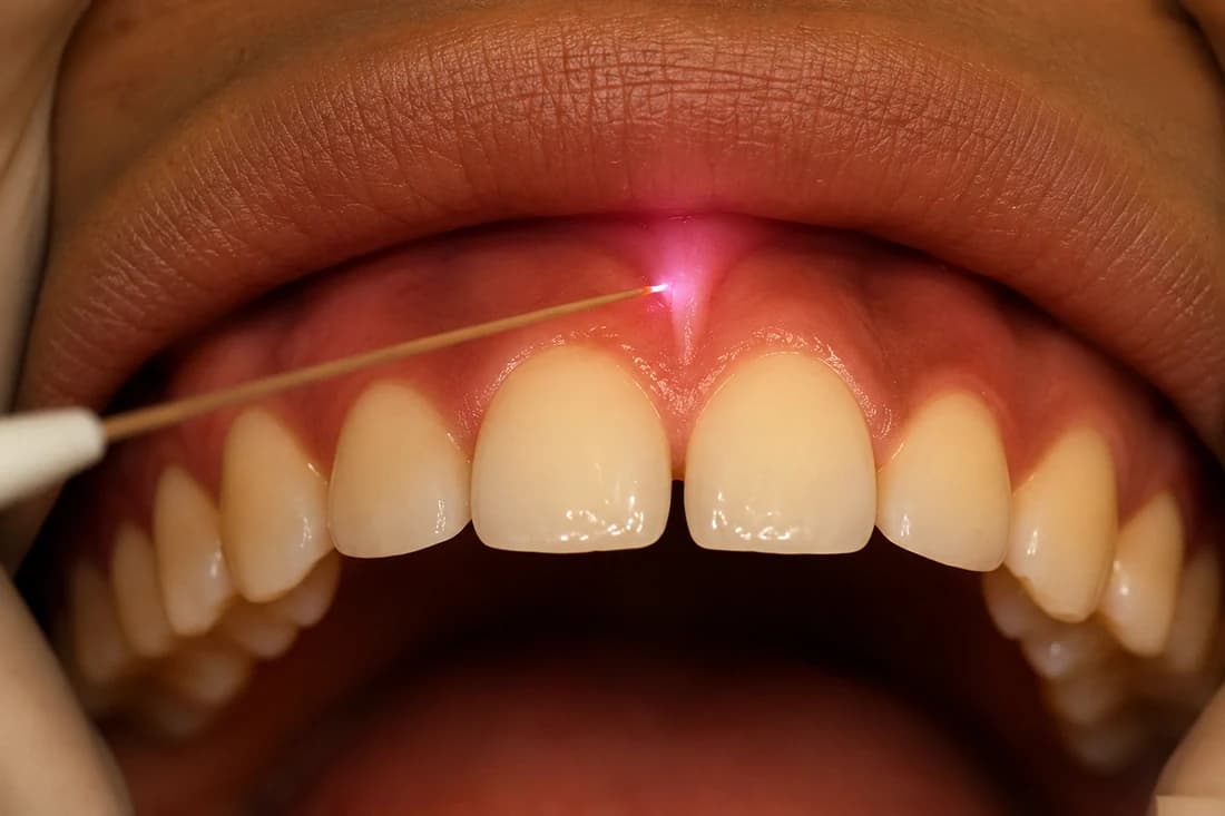 Dentist providing gentle frenectomy care
