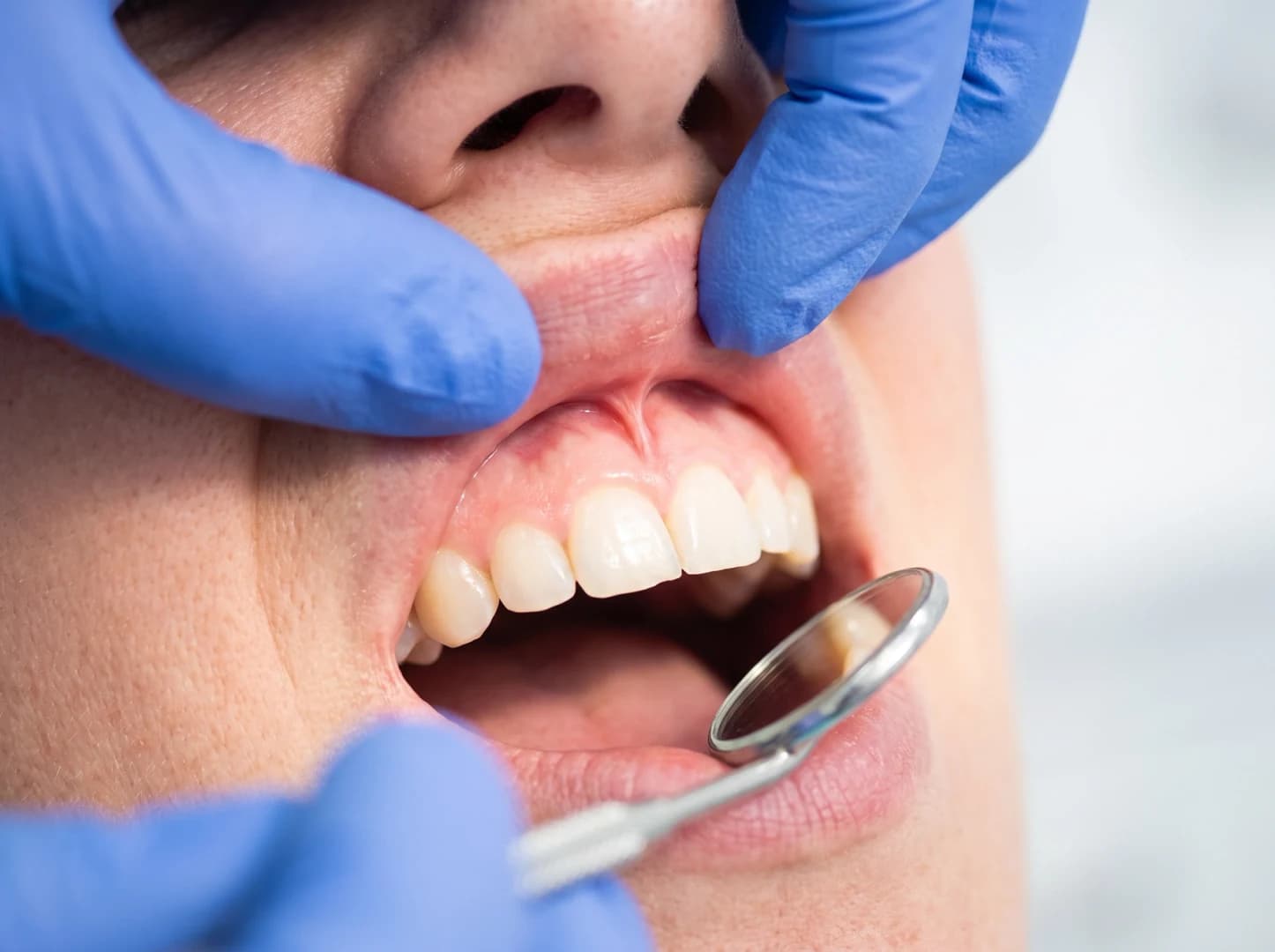 Dentist examining a patient's frenum during an evaluation