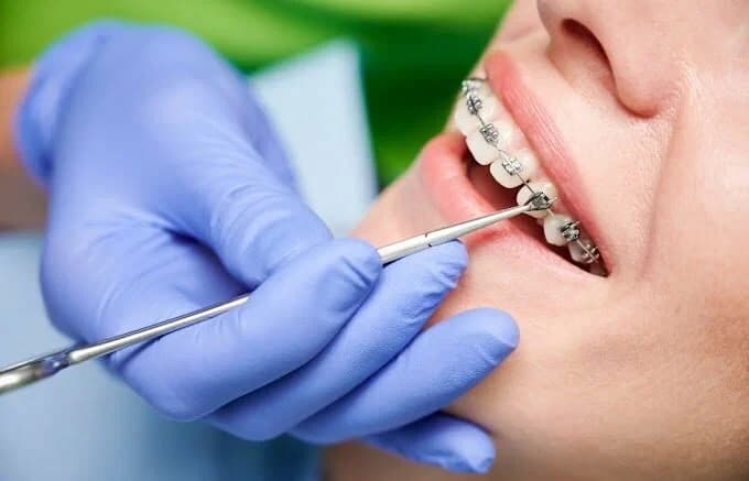 Patient with braces at Peterborough Family Dental