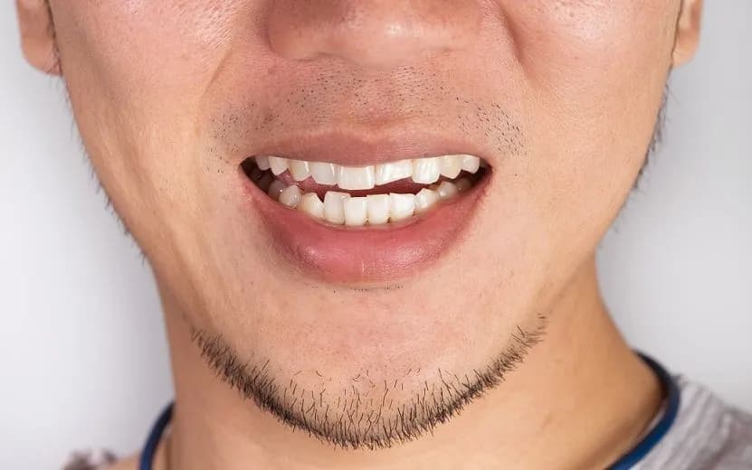 Close-up of a patient's chipped front tooth