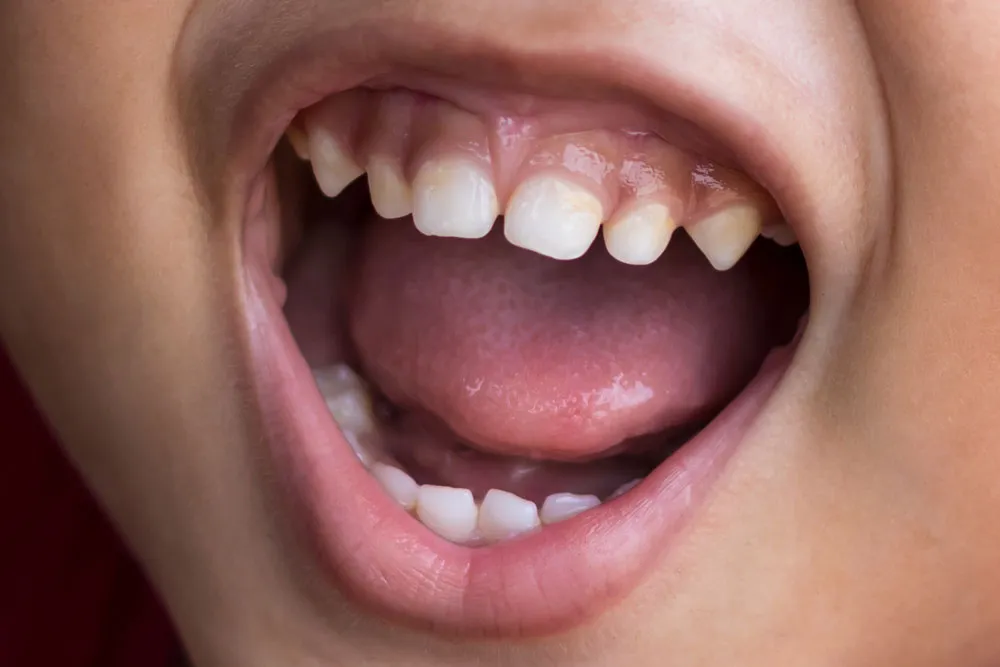 Dentist providing gentle frenectomy care