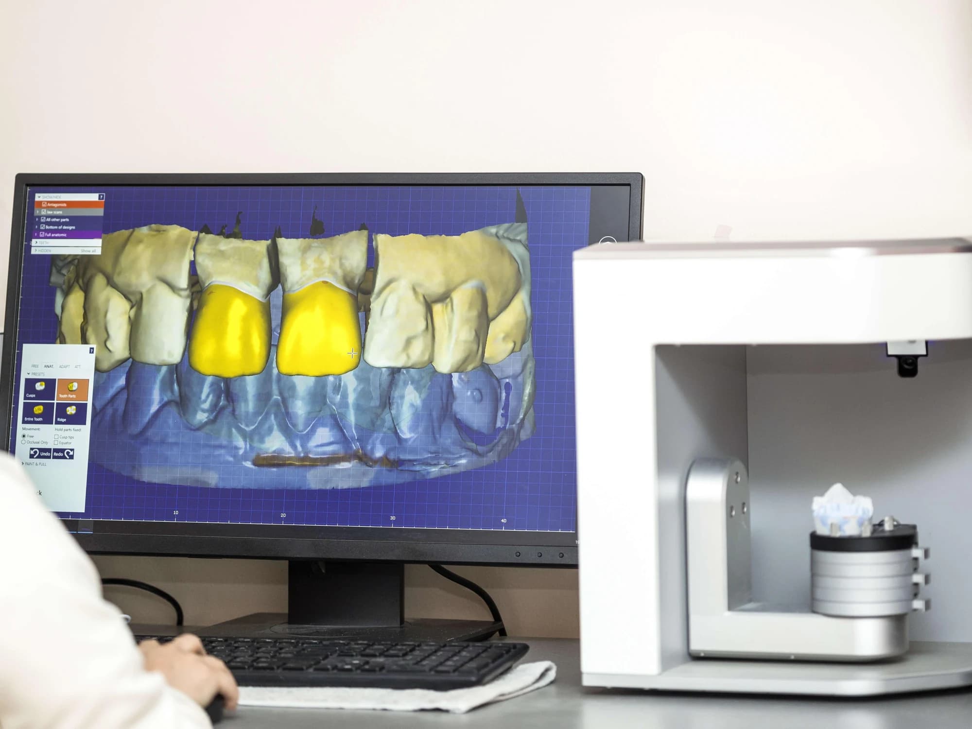 A 3D CT scan of a patient's jaw displayed on screen