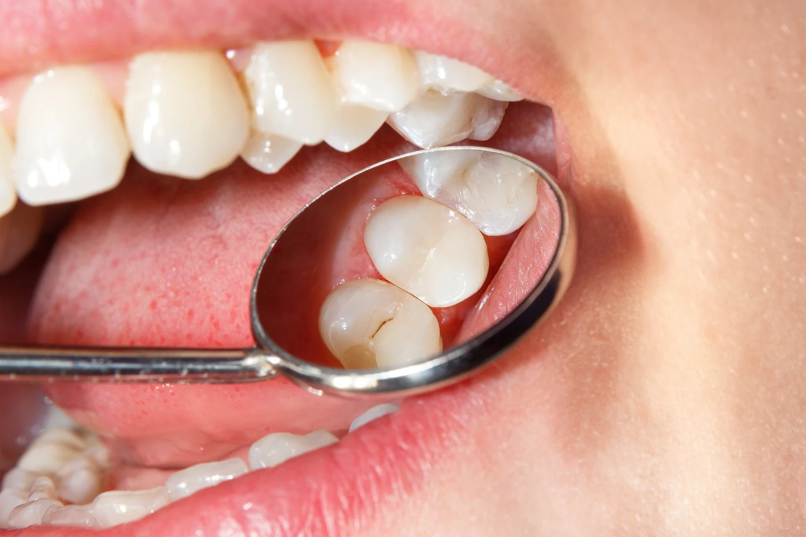 Routine dental check showing minimal decay suitable for a simple filling