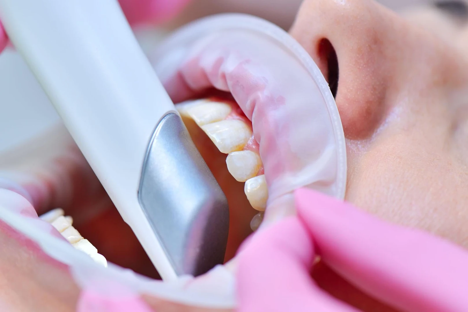 3D digital scan of natural teeth showing precise detail for crown fabrication