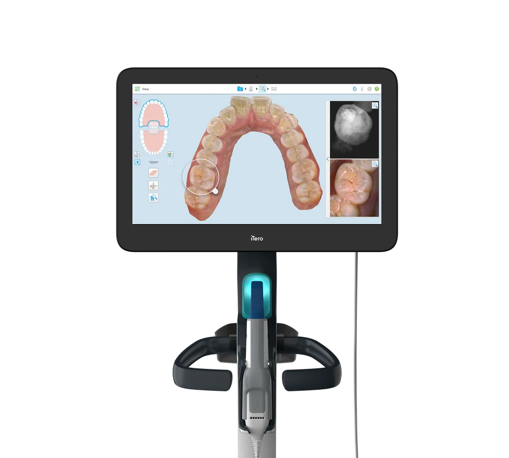The iTero scanner in our office, showing a 3D scan of a patient's upper arch on screen