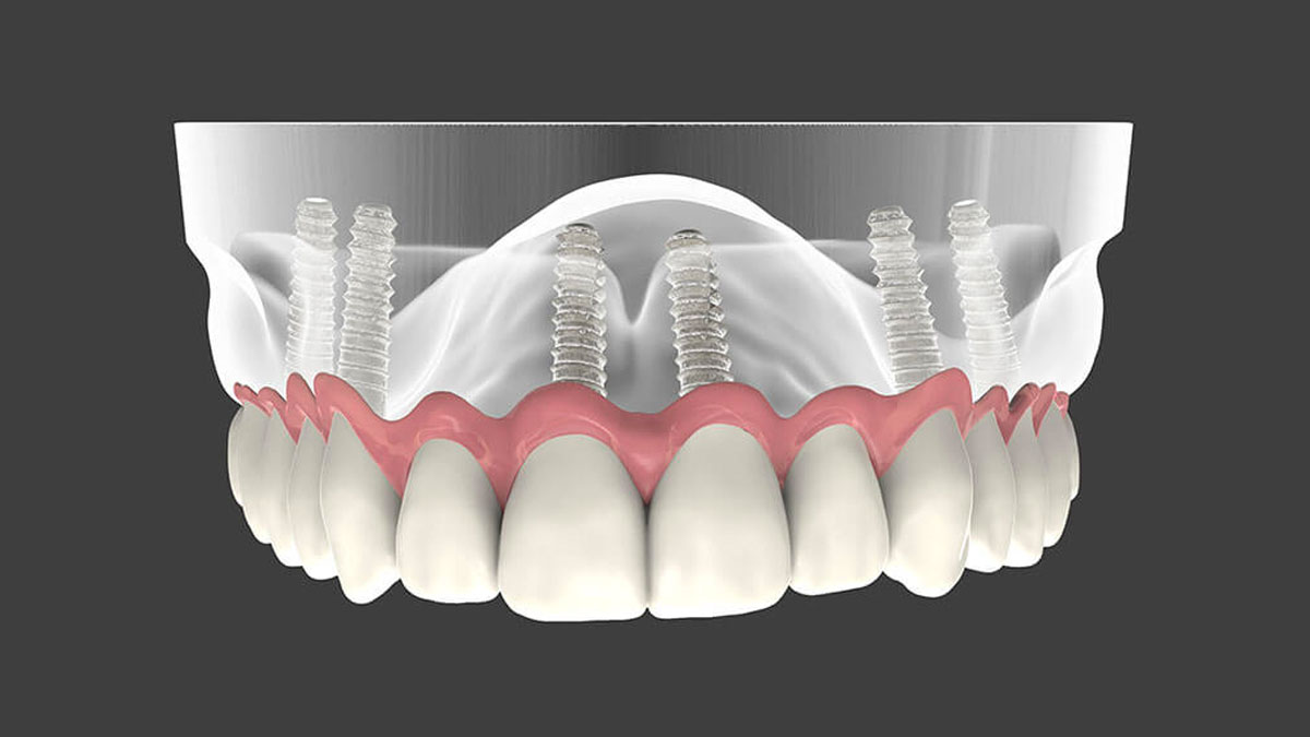 Dental Implants